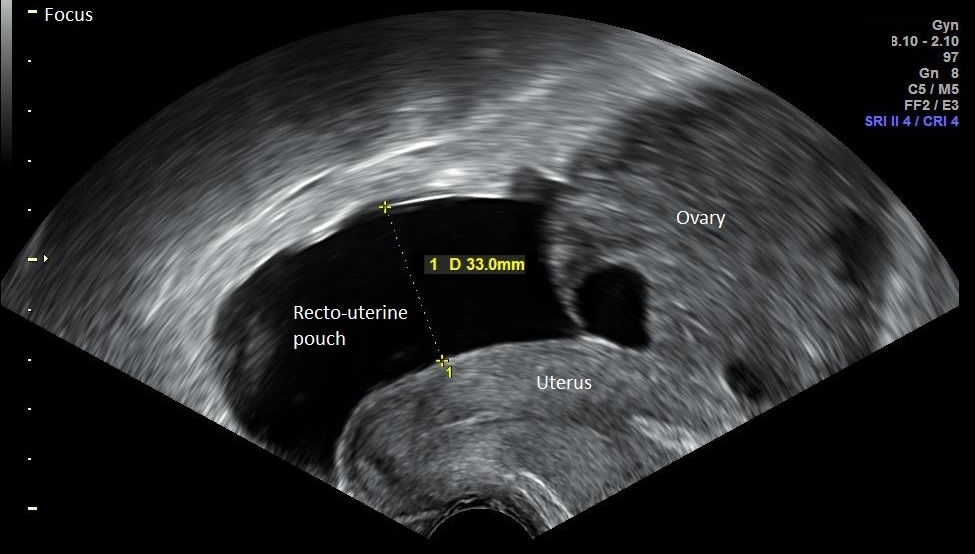 Ecografía transvaginal