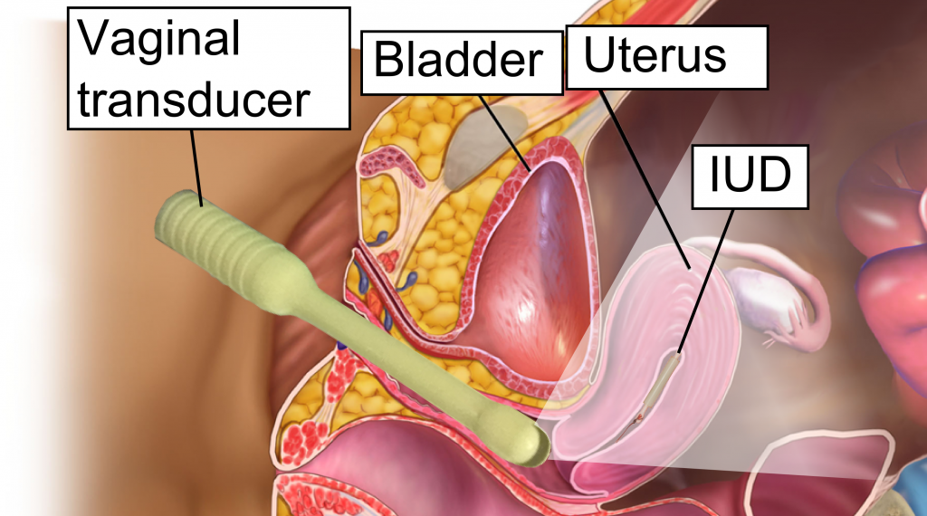 Ecografía transvaginal